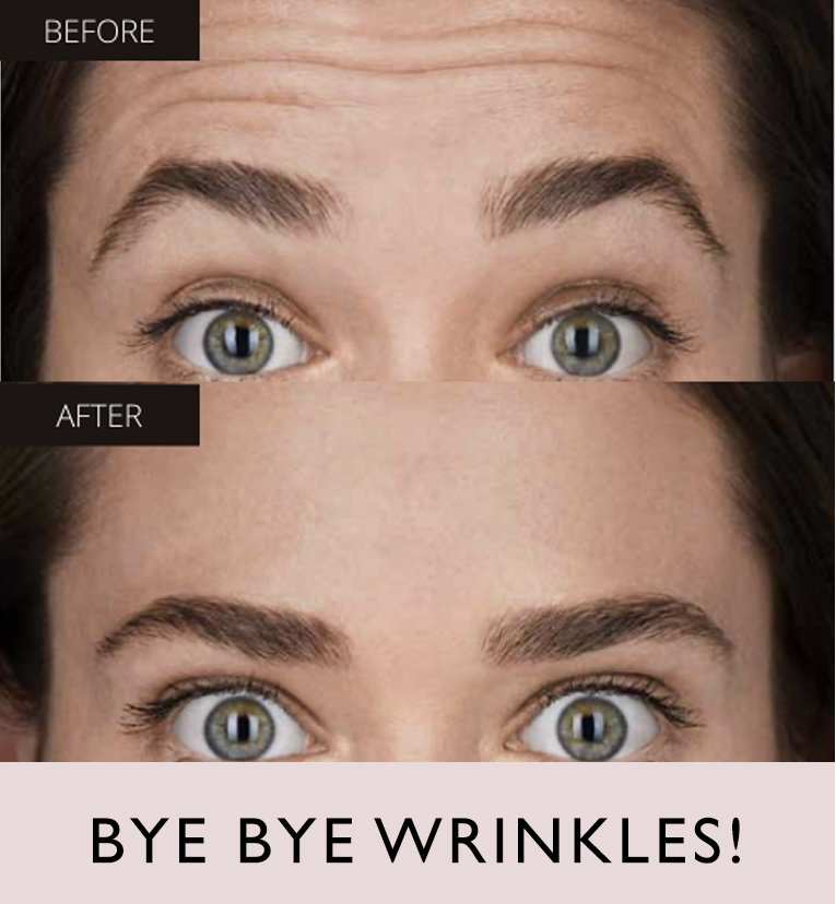 Botox1-2