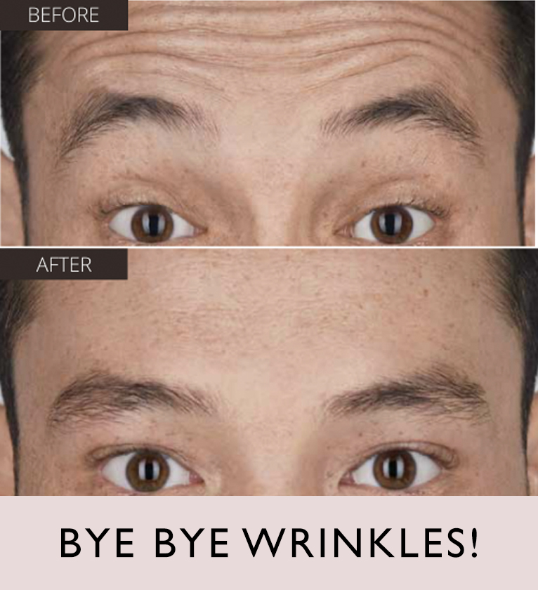 Botox3-2