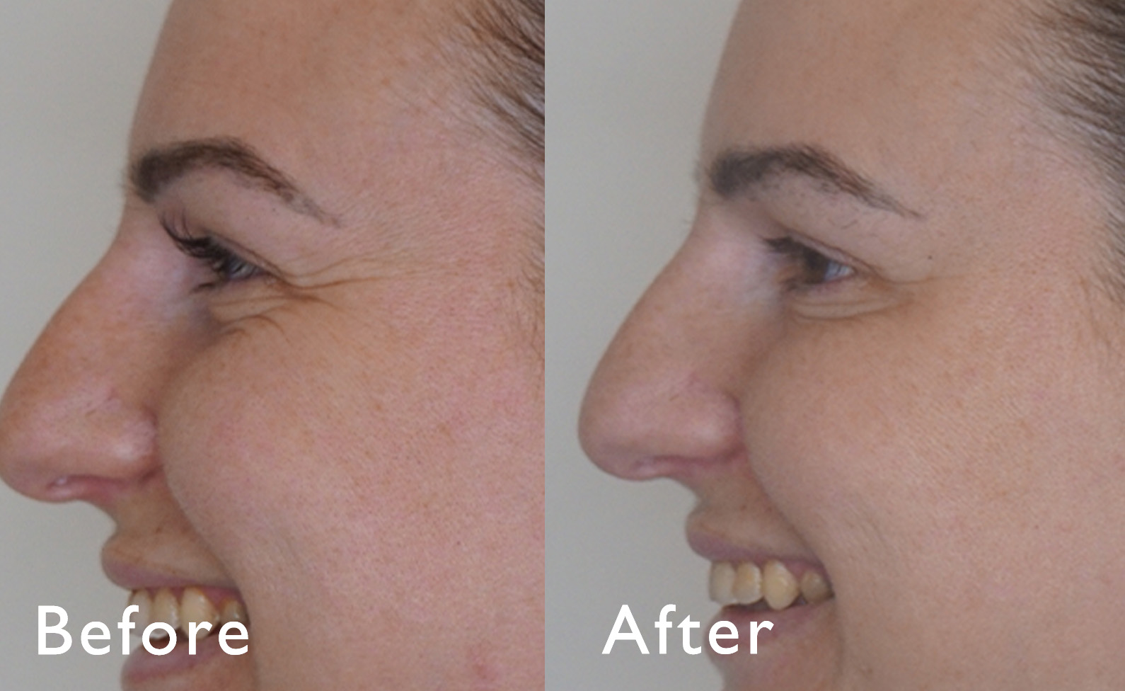 BWMS BandACrows feet 1