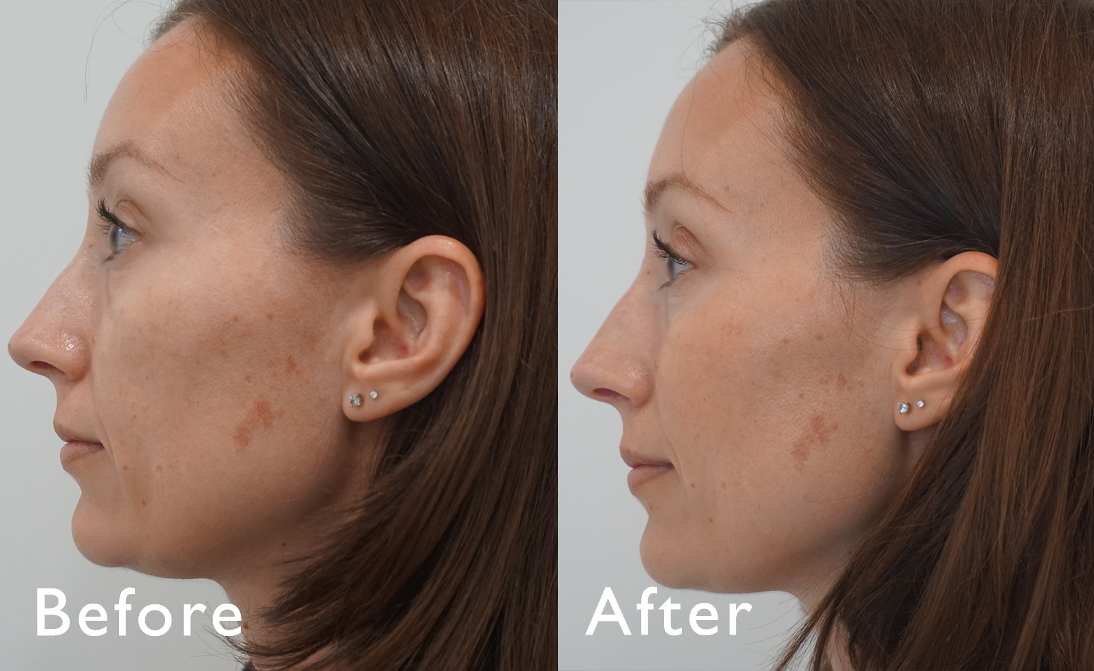 BWMS BeWell MedSpa before and after template copy banda fillers